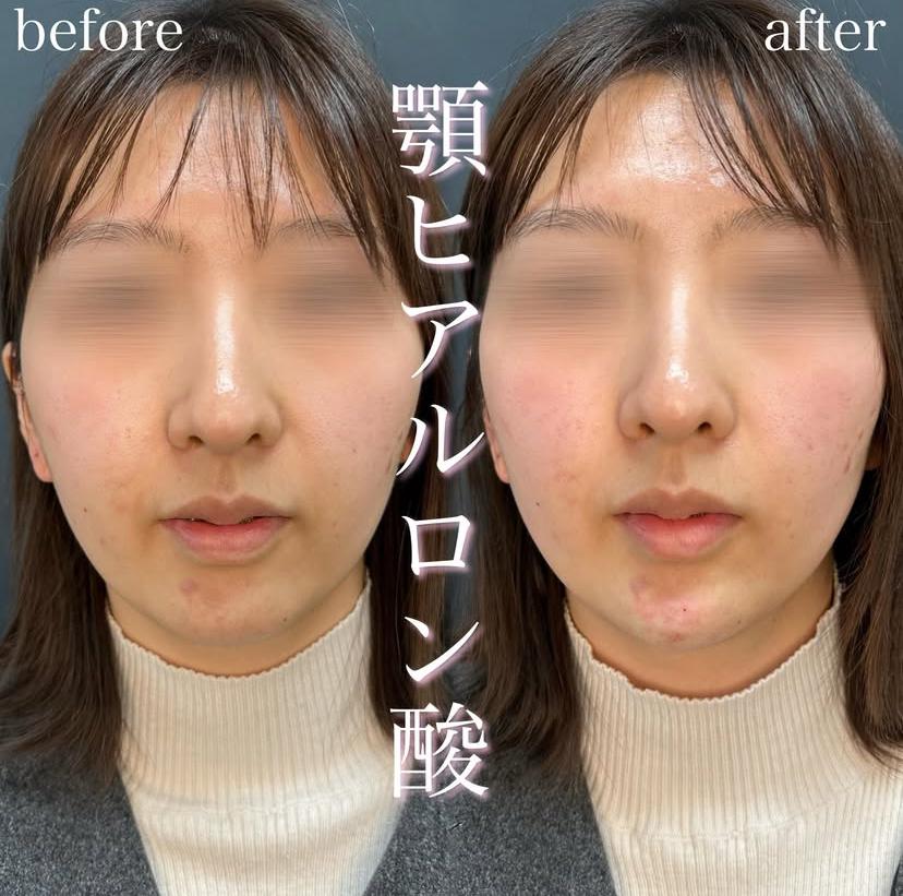 アゴクレヴィエルの症例写真