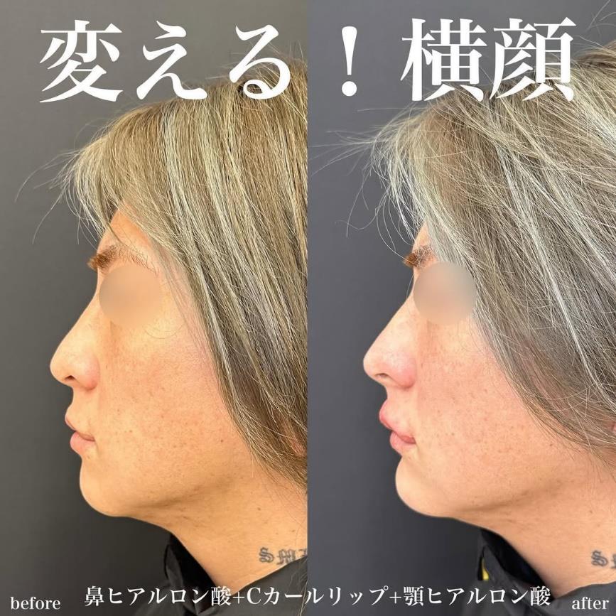 アゴクレヴィエルの症例写真