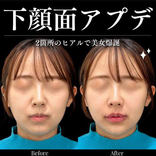 アゴクレヴィエルの症例写真