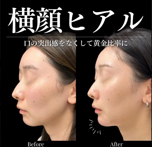 アゴクレヴィエルの症例写真