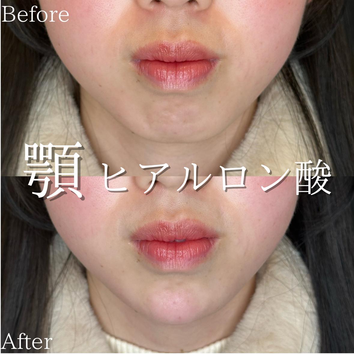 アゴクレヴィエルの症例写真