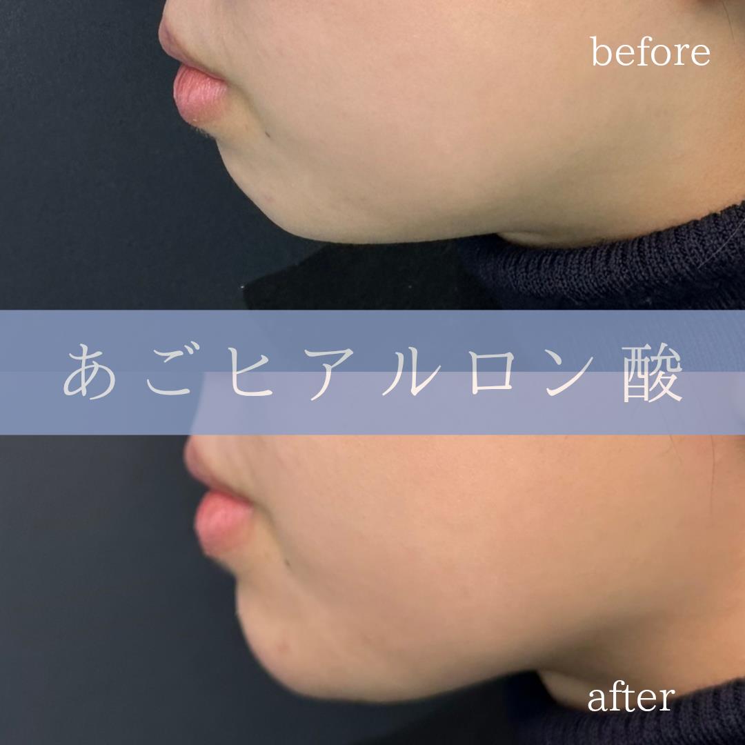 アゴクレヴィエルの症例写真