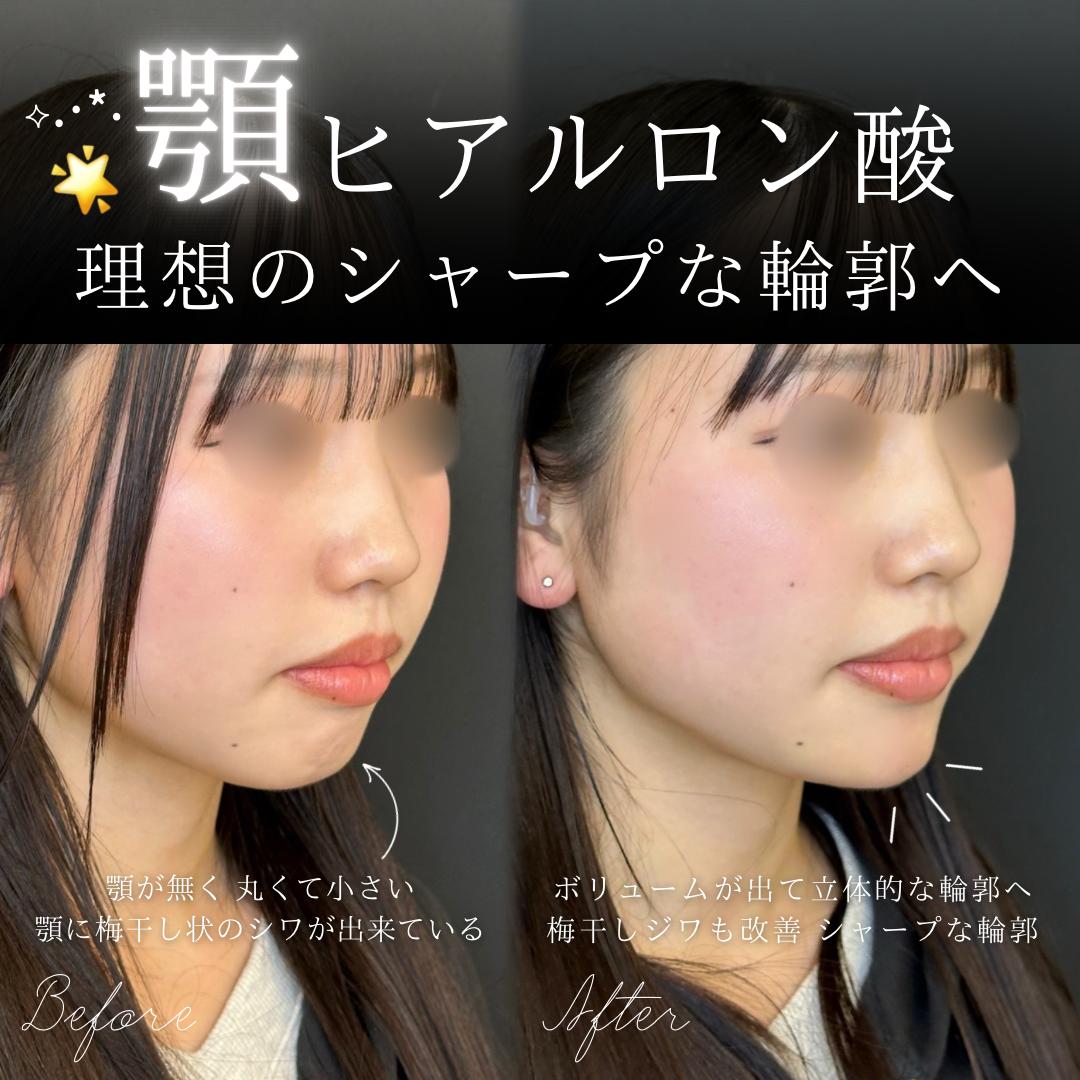アゴクレヴィエルの症例写真