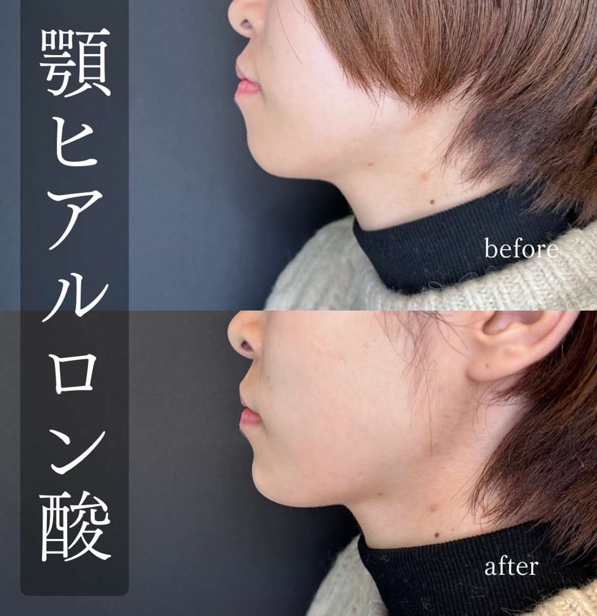 アゴクレヴィエルの症例写真