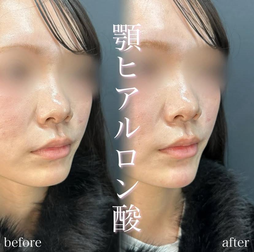 アゴクレヴィエルの症例写真