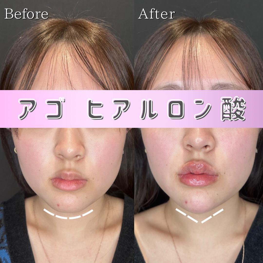 アゴクレヴィエルの症例写真