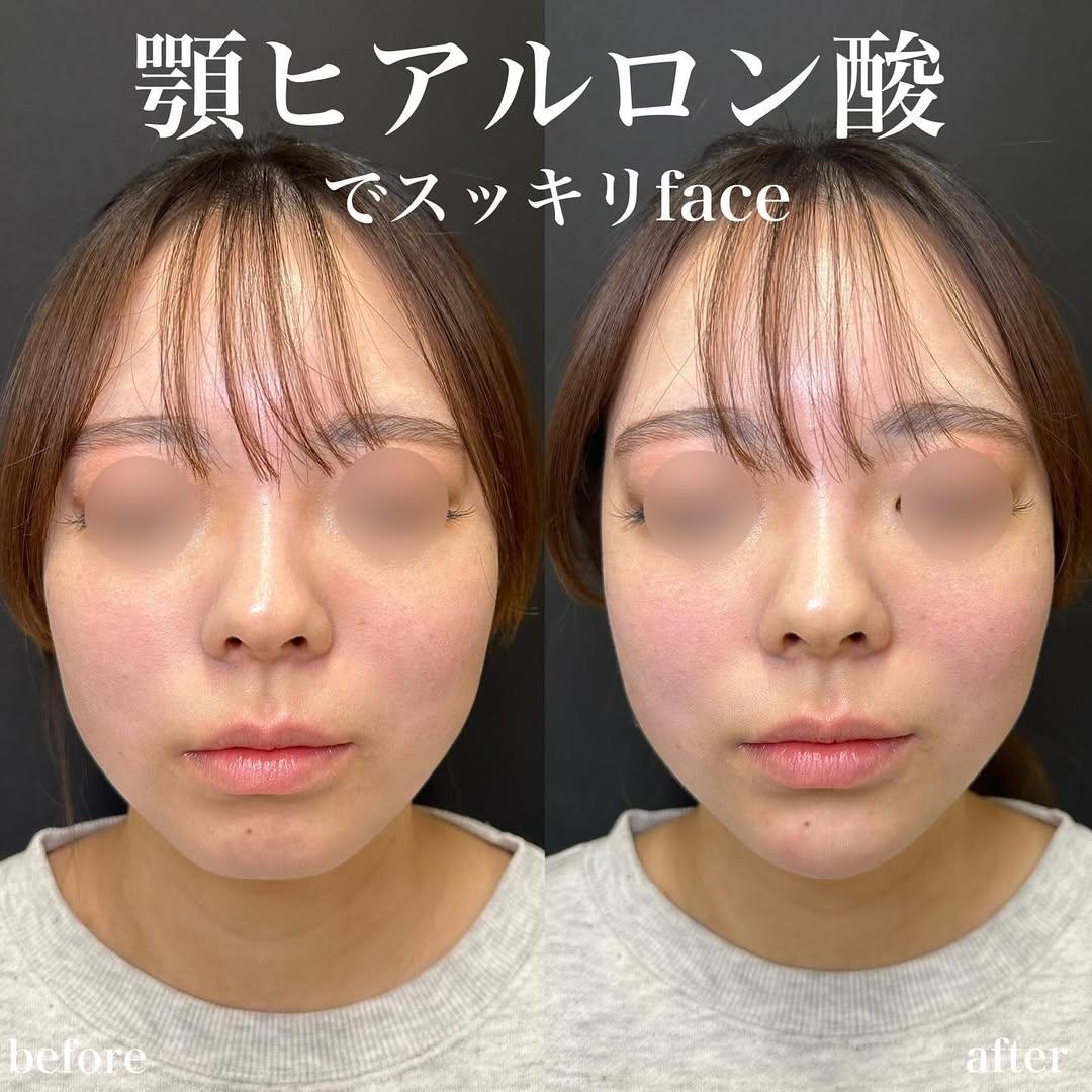 アゴクレヴィエルの症例写真