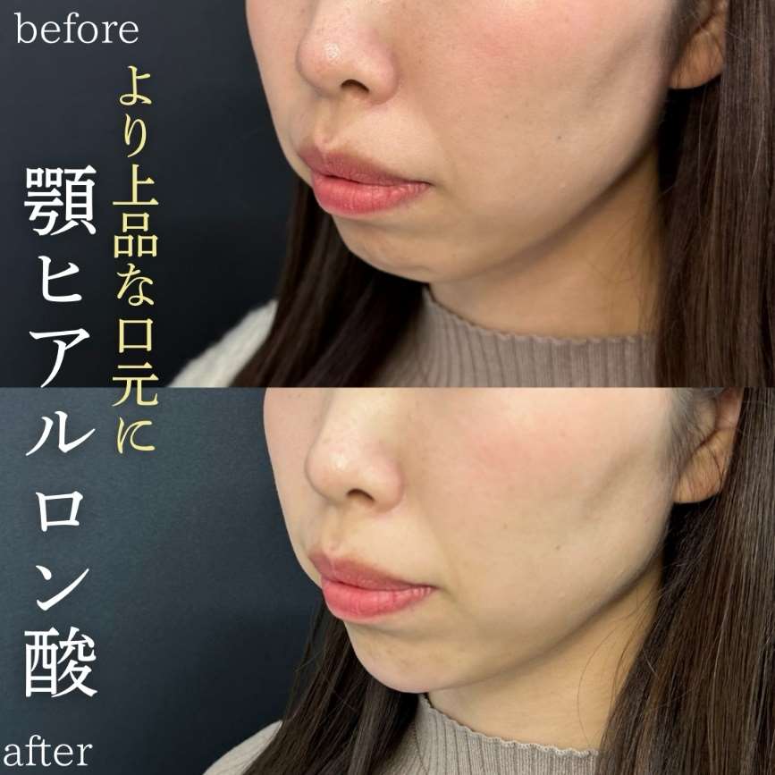 アゴクレヴィエルの症例写真