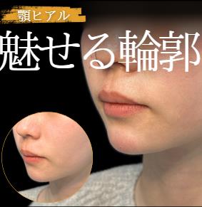アゴクレヴィエルの症例写真