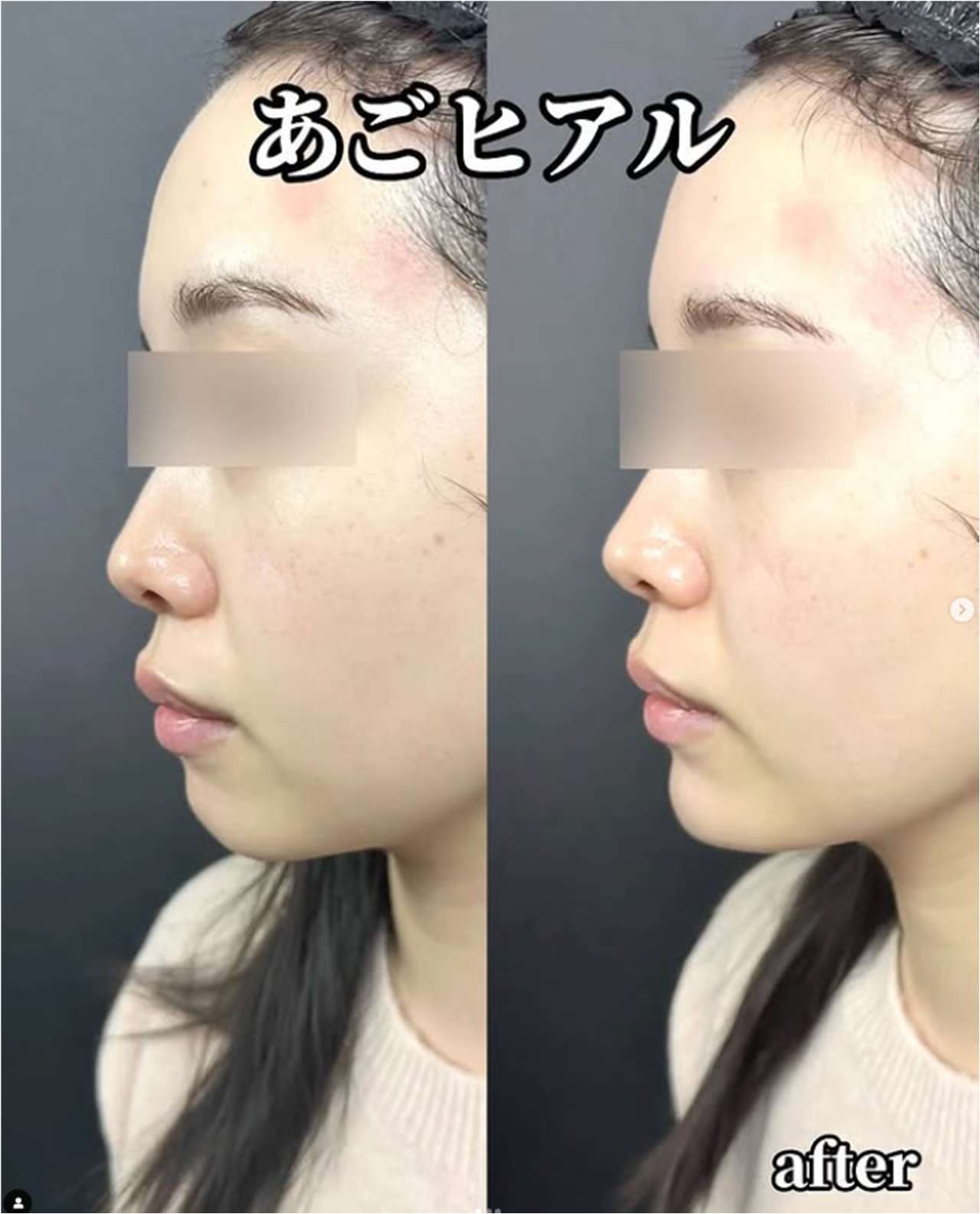 アゴクレヴィエルの症例写真