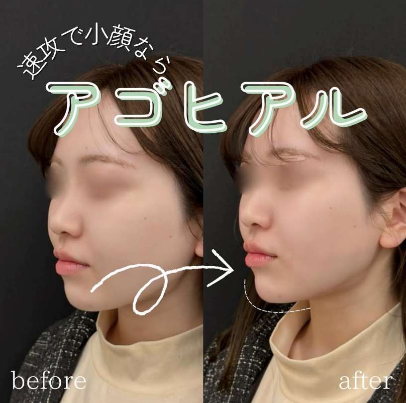 アゴクレヴィエルの症例写真