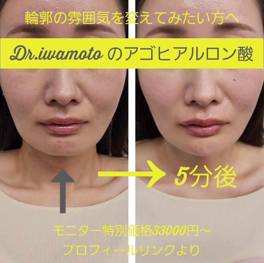 アゴクレヴィエルの症例写真
