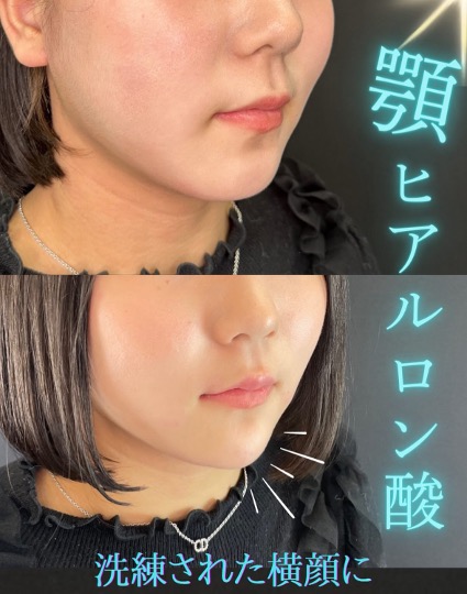 アゴクレヴィエルの症例写真