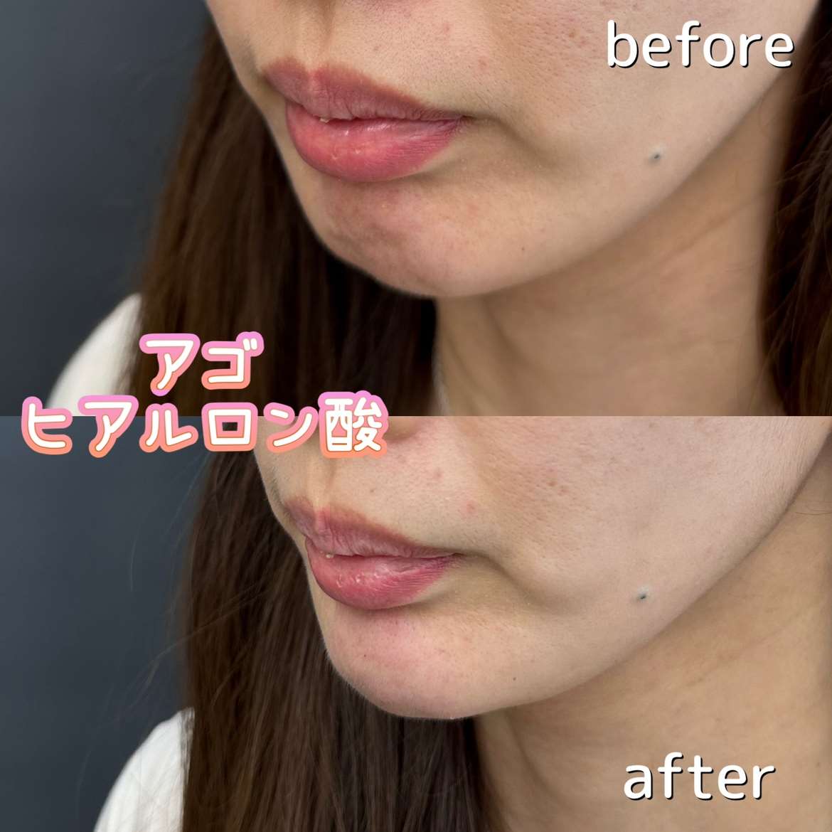 アゴクレヴィエルの症例写真