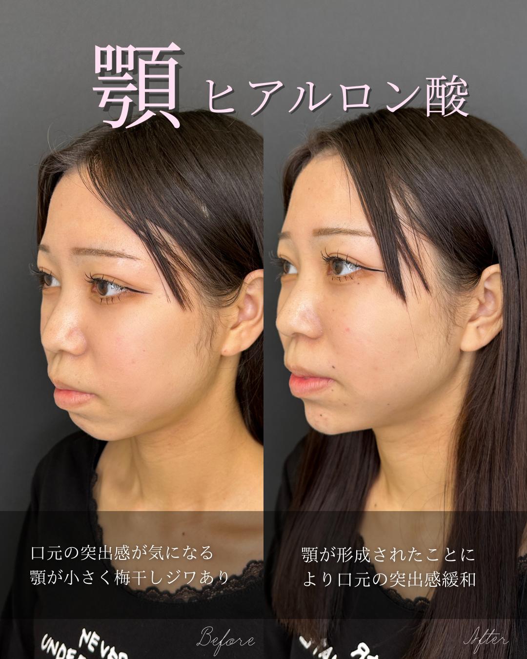 アゴクレヴィエルの症例写真