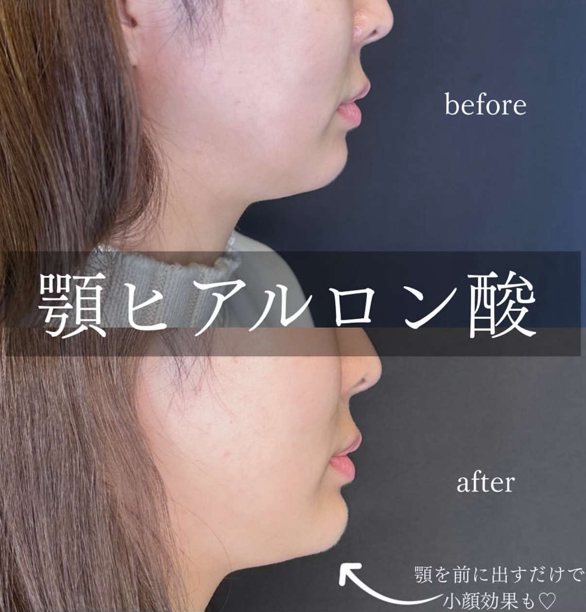 アゴクレヴィエルの症例写真