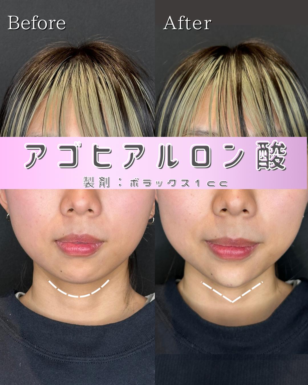 アゴクレヴィエルの症例写真