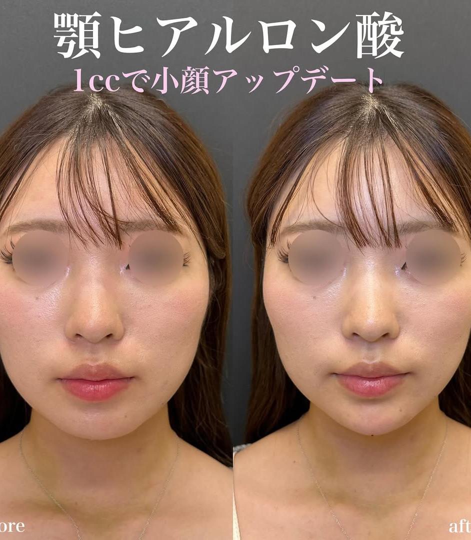 アゴクレヴィエルの症例写真