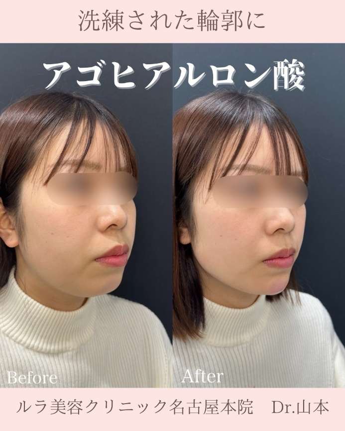 アゴクレヴィエルの症例写真