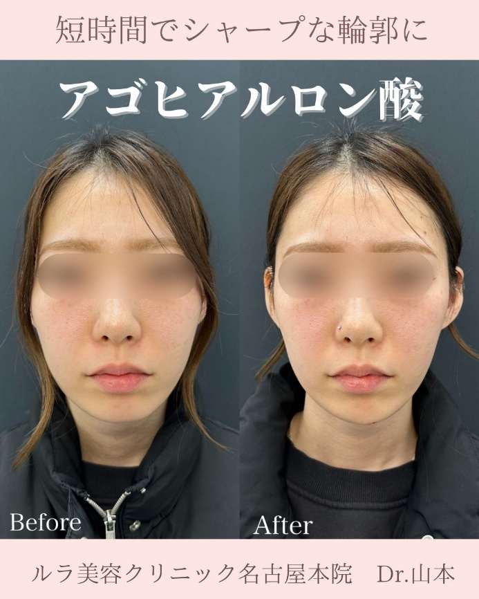 アゴクレヴィエルの症例写真