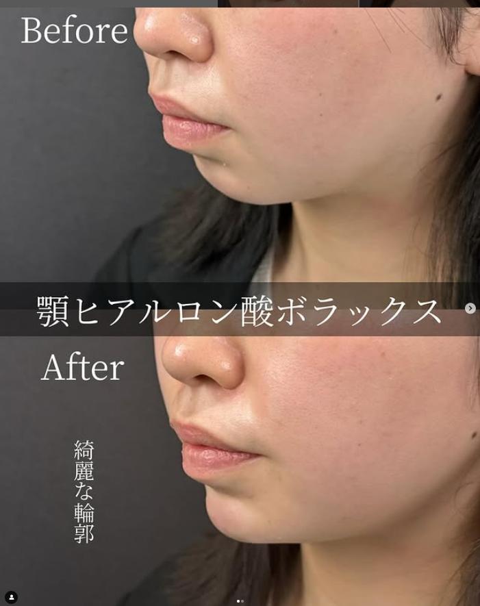 アゴクレヴィエルの症例写真