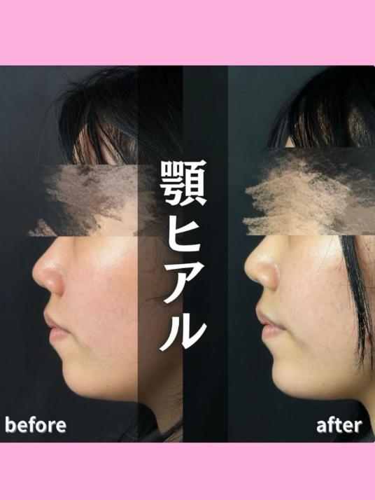 アゴクレヴィエルの症例写真