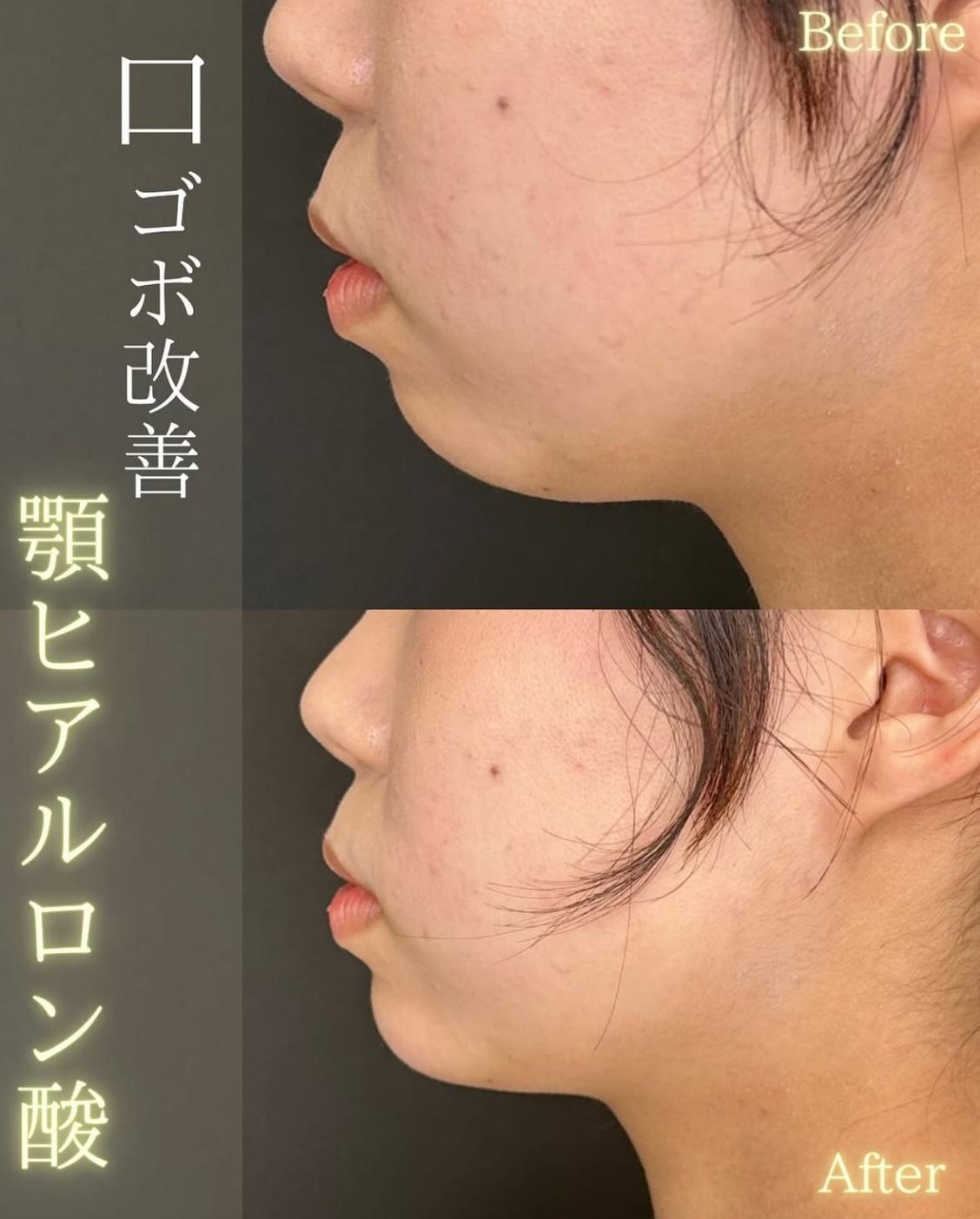 アゴクレヴィエルの症例写真