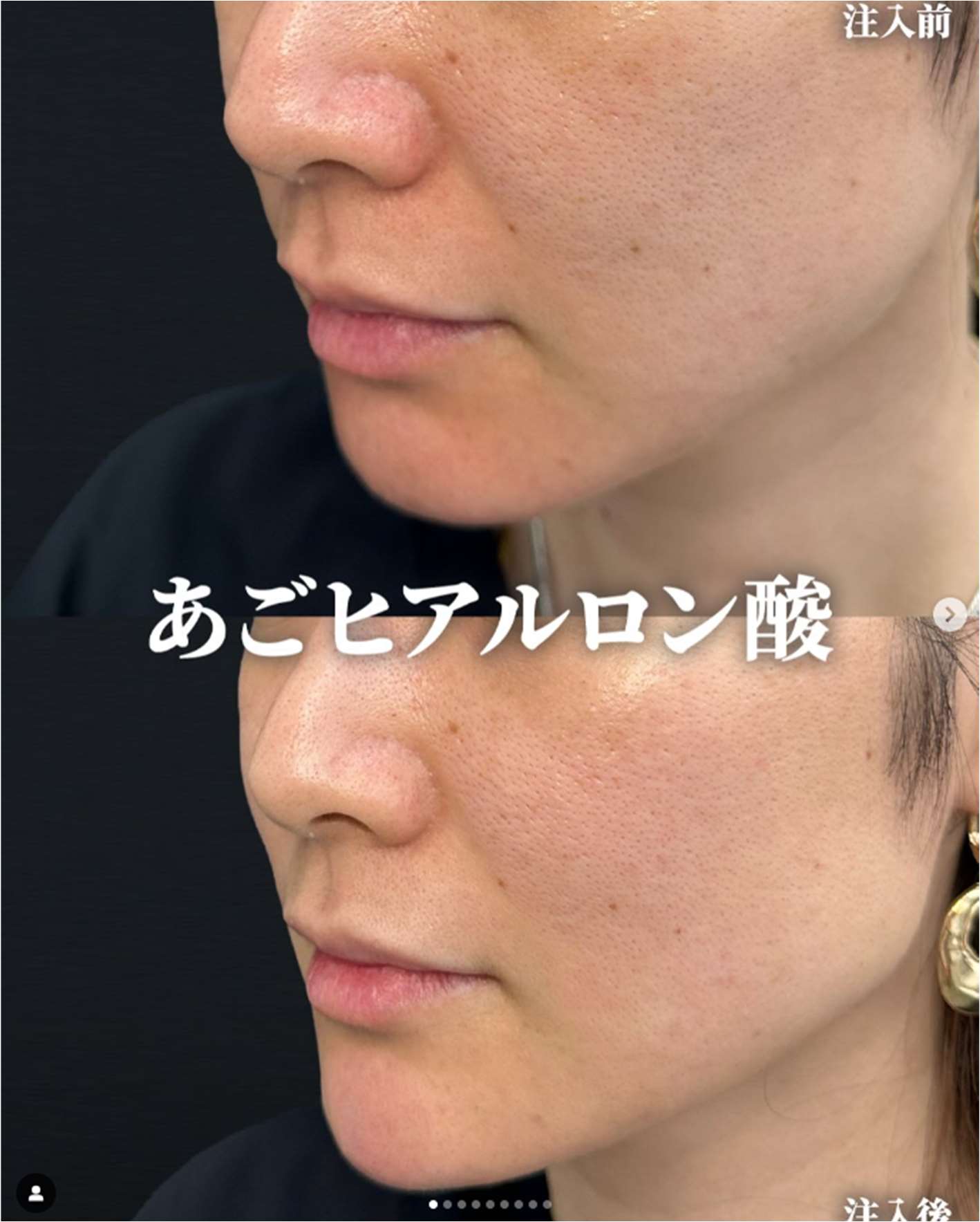 アゴクレヴィエルの症例写真