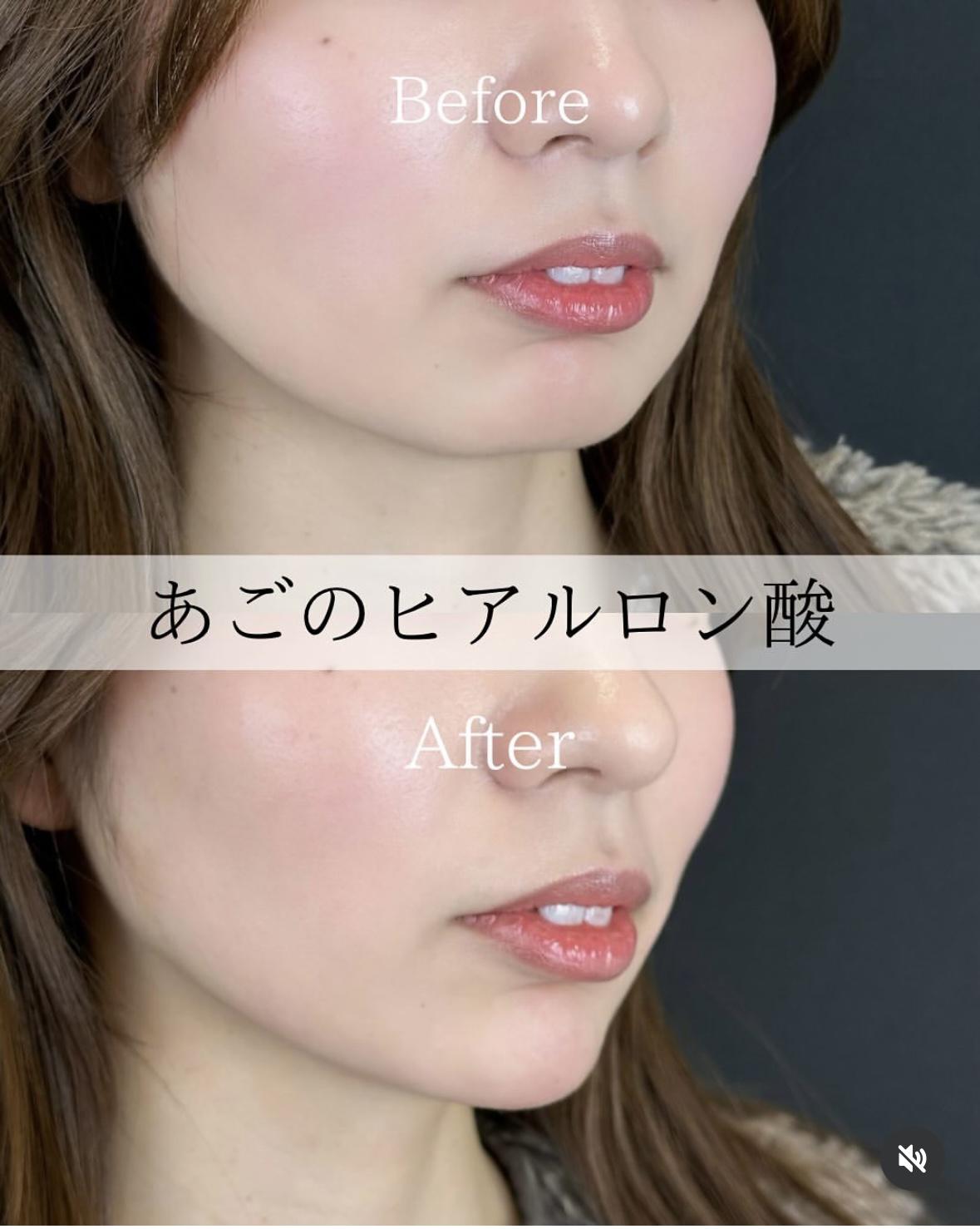 アゴクレヴィエルの症例写真