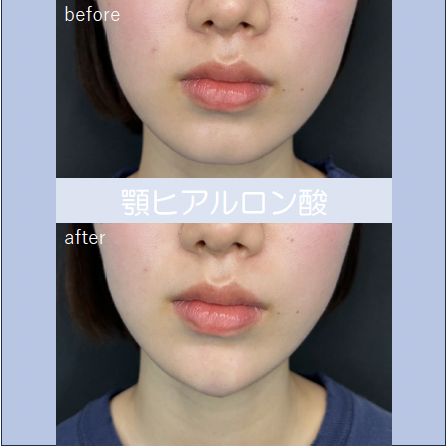 アゴクレヴィエルの症例写真