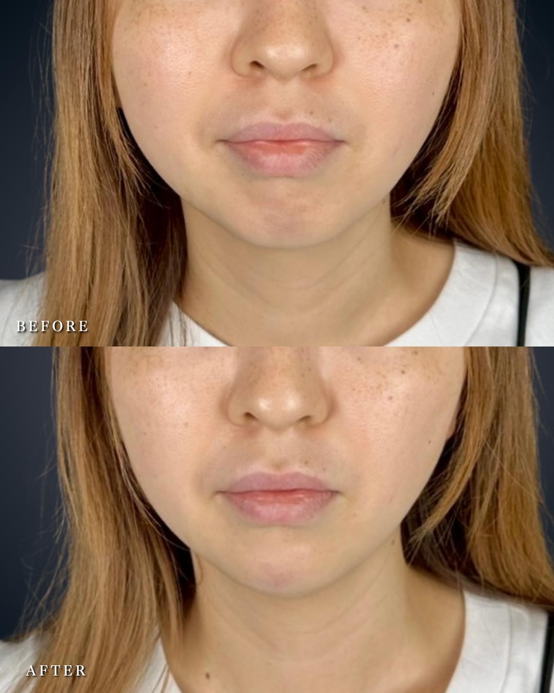 アゴクレヴィエルの症例写真