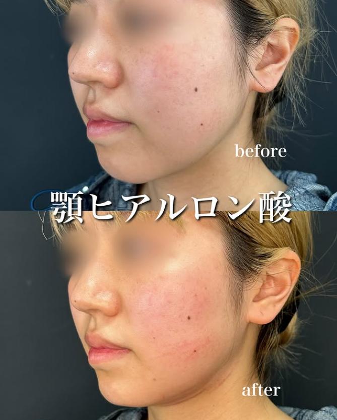 アゴクレヴィエルの症例写真