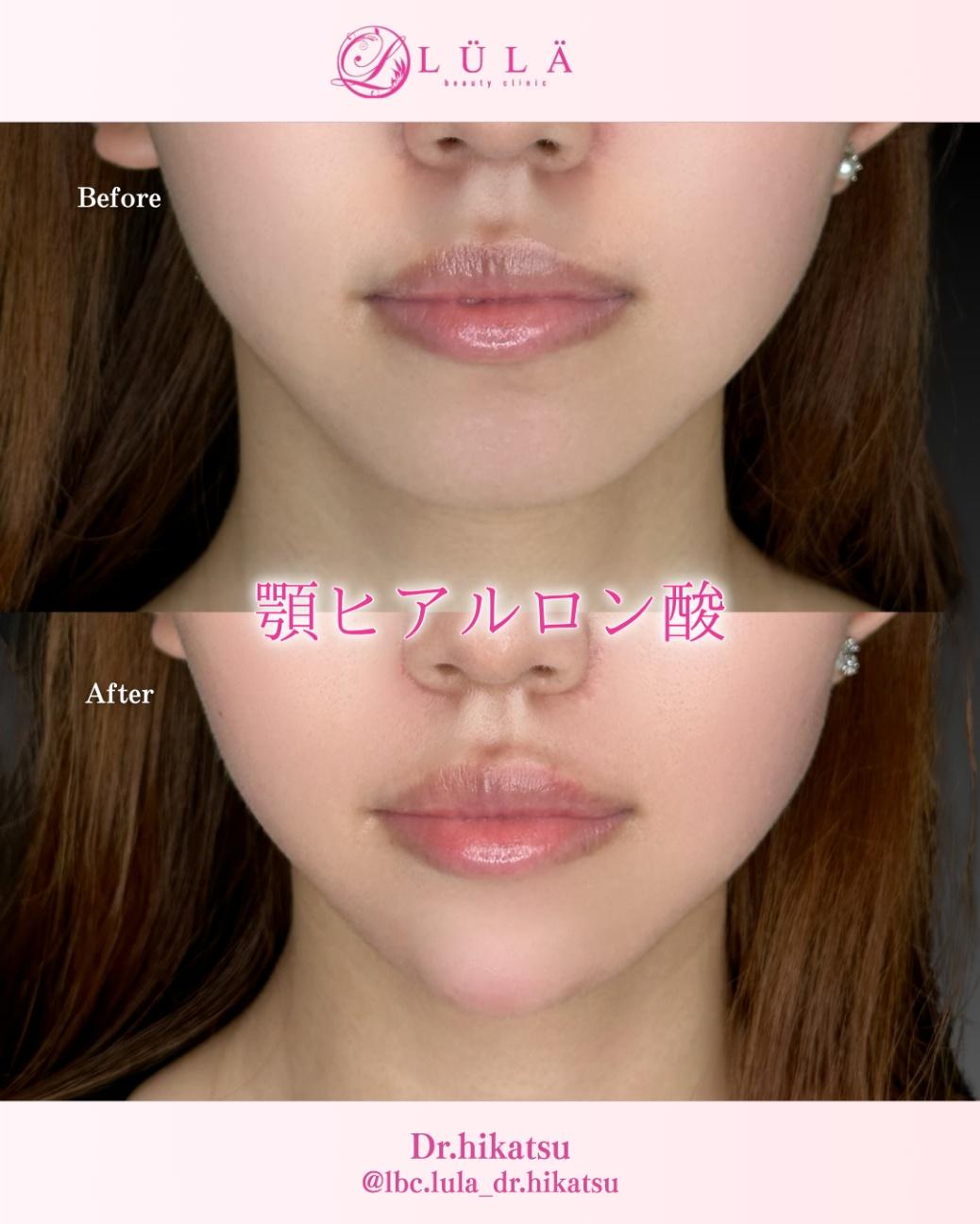 アゴクレヴィエルの症例写真