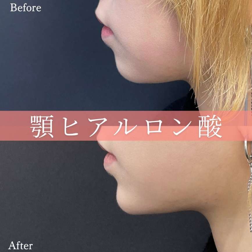 アゴクレヴィエルの症例写真