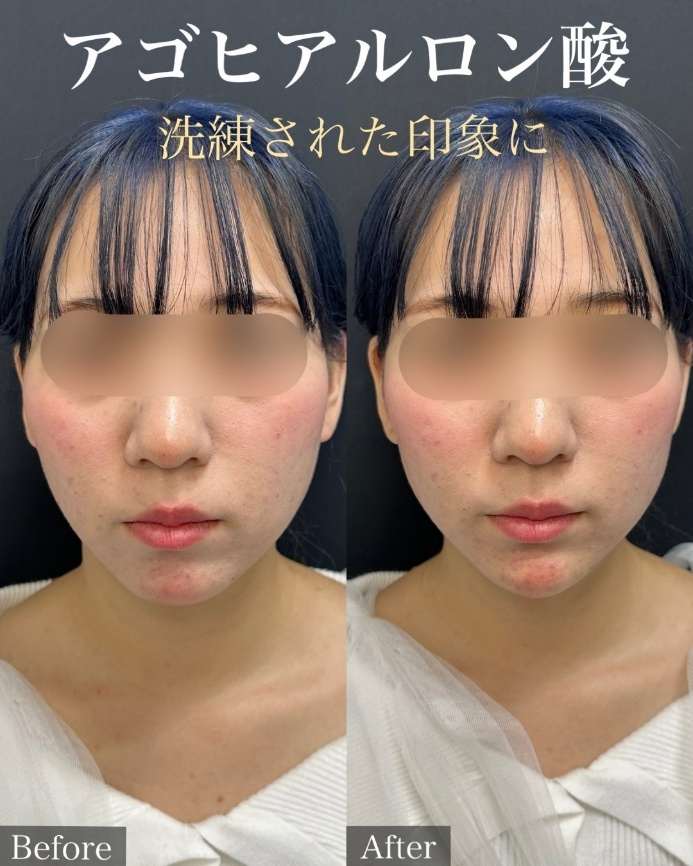 アゴクレヴィエルの症例写真