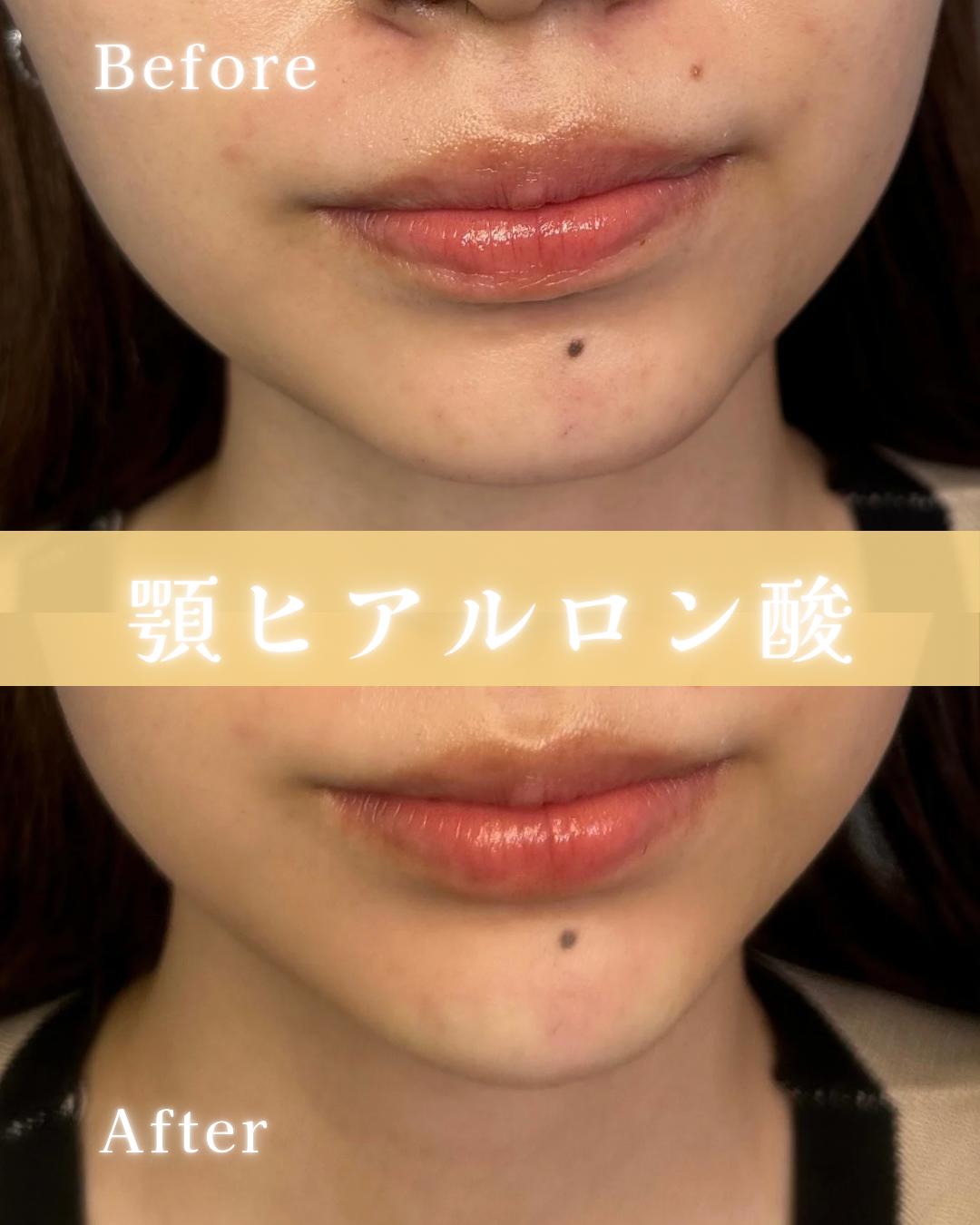 アゴクレヴィエルの症例写真