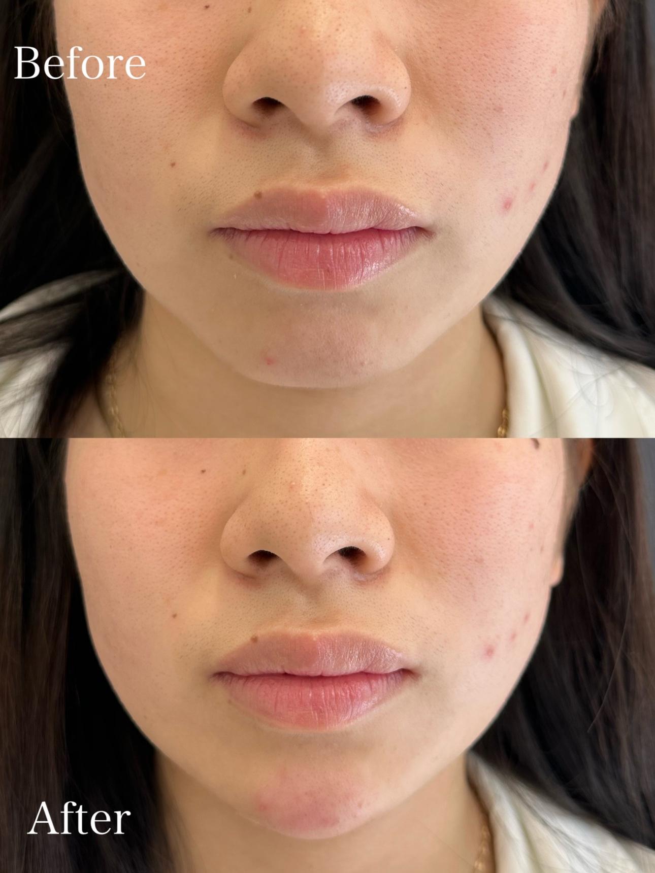 アゴクレヴィエルの症例写真