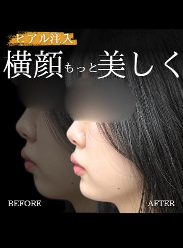 アゴクレヴィエルの症例写真