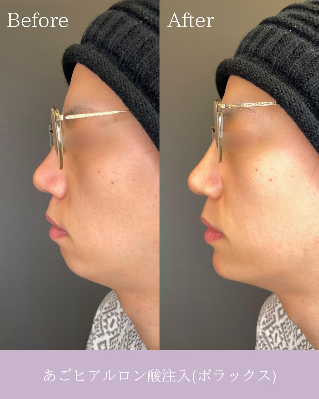 アゴクレヴィエルの症例写真