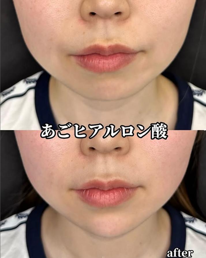 アゴクレヴィエルの症例写真