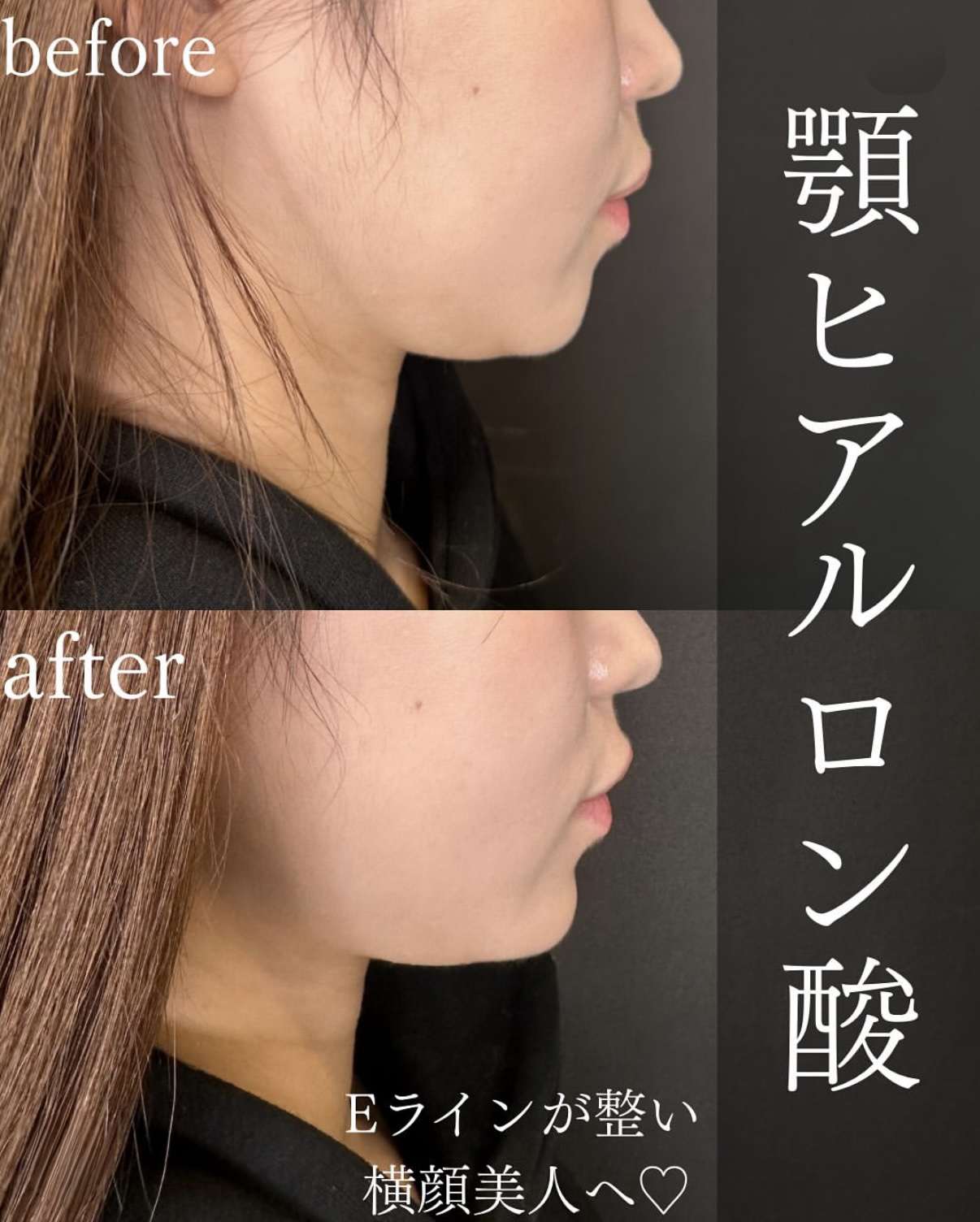 アゴクレヴィエルの症例写真