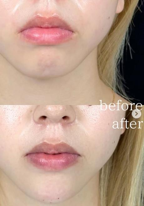 アゴクレヴィエルの症例写真