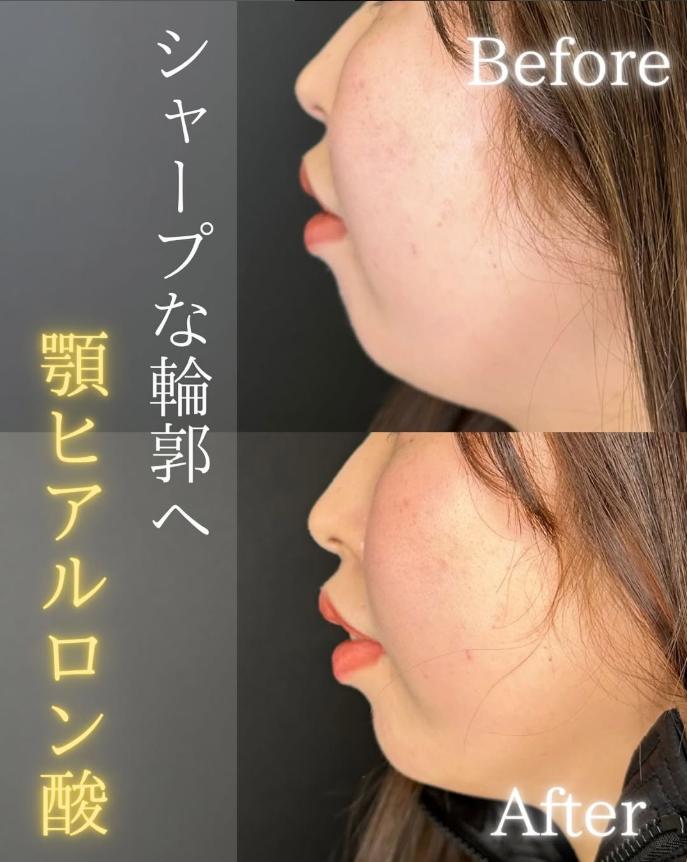 アゴクレヴィエルの症例写真