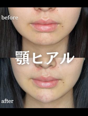 アゴクレヴィエルの症例写真