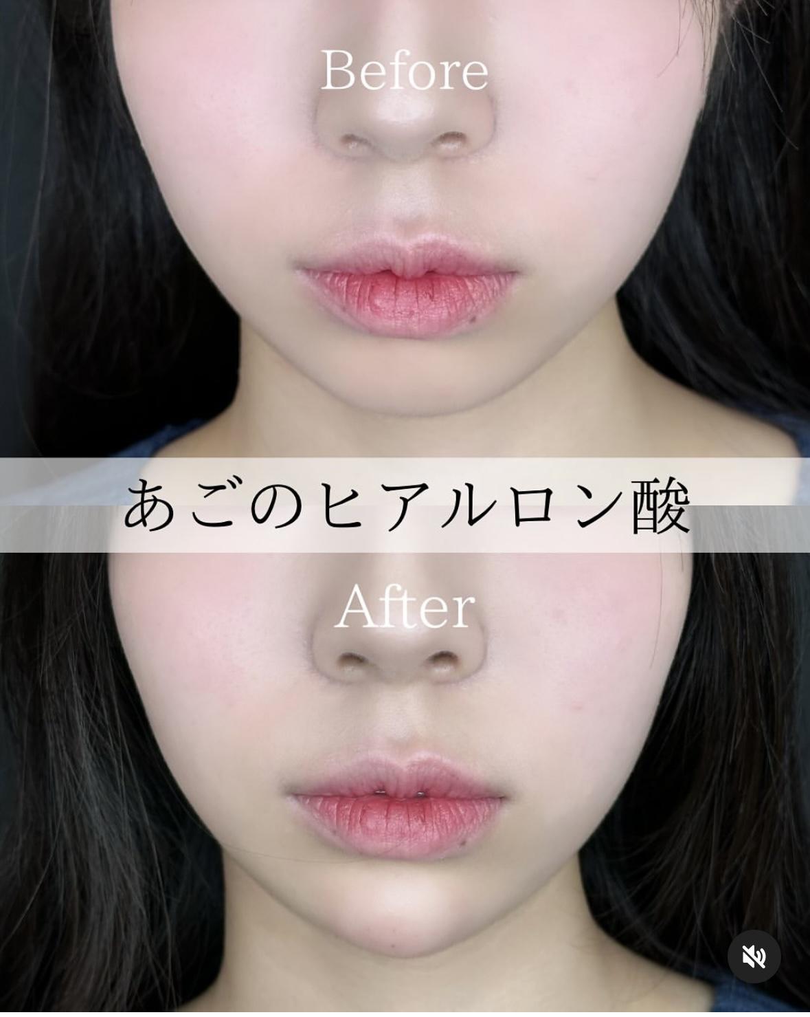 アゴクレヴィエルの症例写真