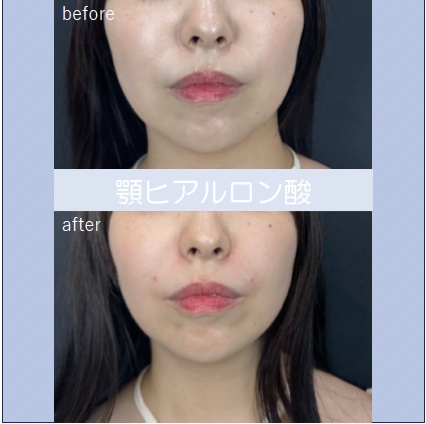 アゴクレヴィエルの症例写真