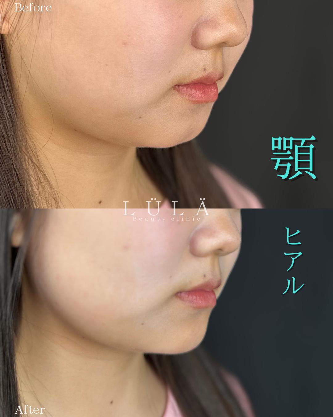 アゴクレヴィエルの症例写真