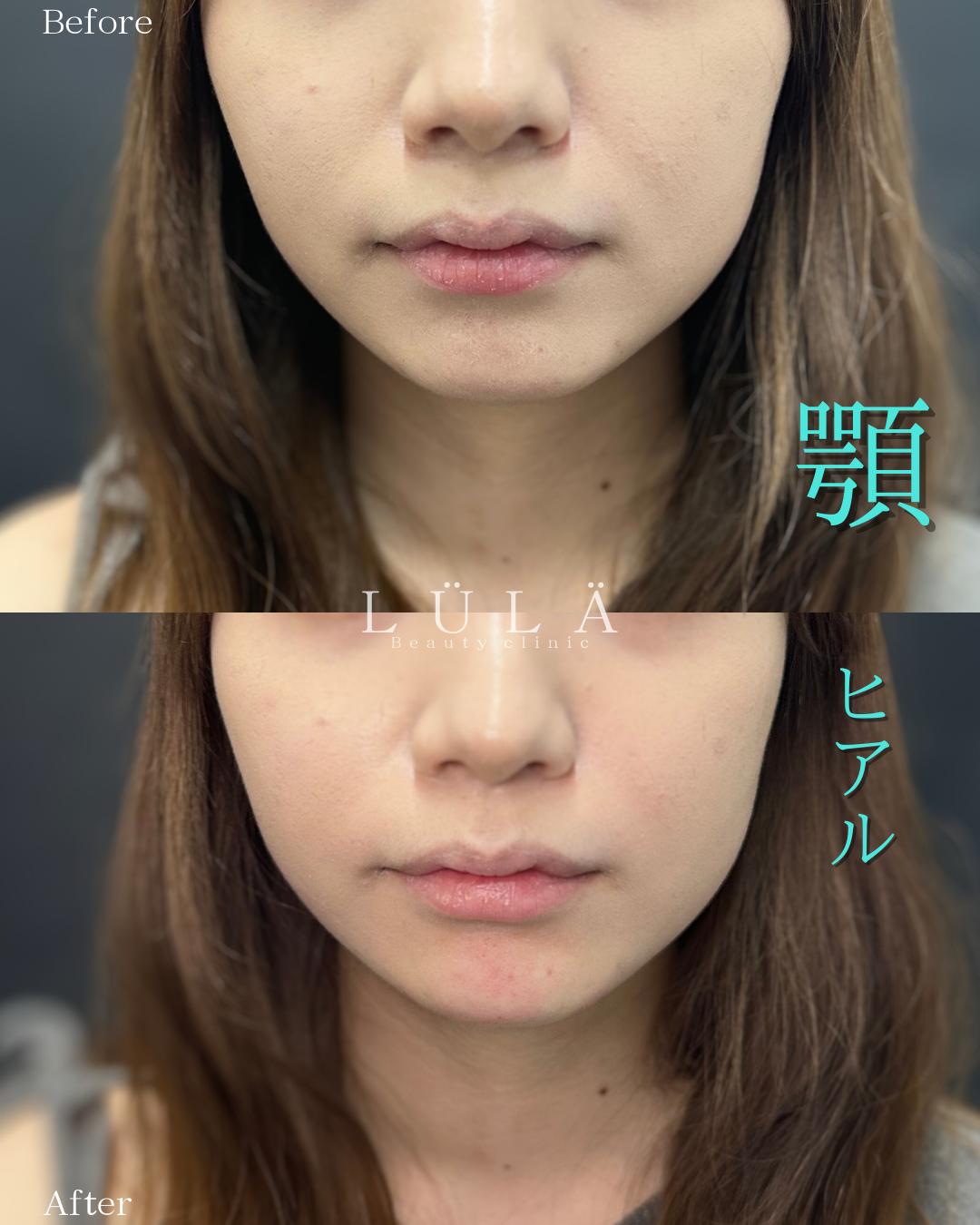 アゴクレヴィエルの症例写真