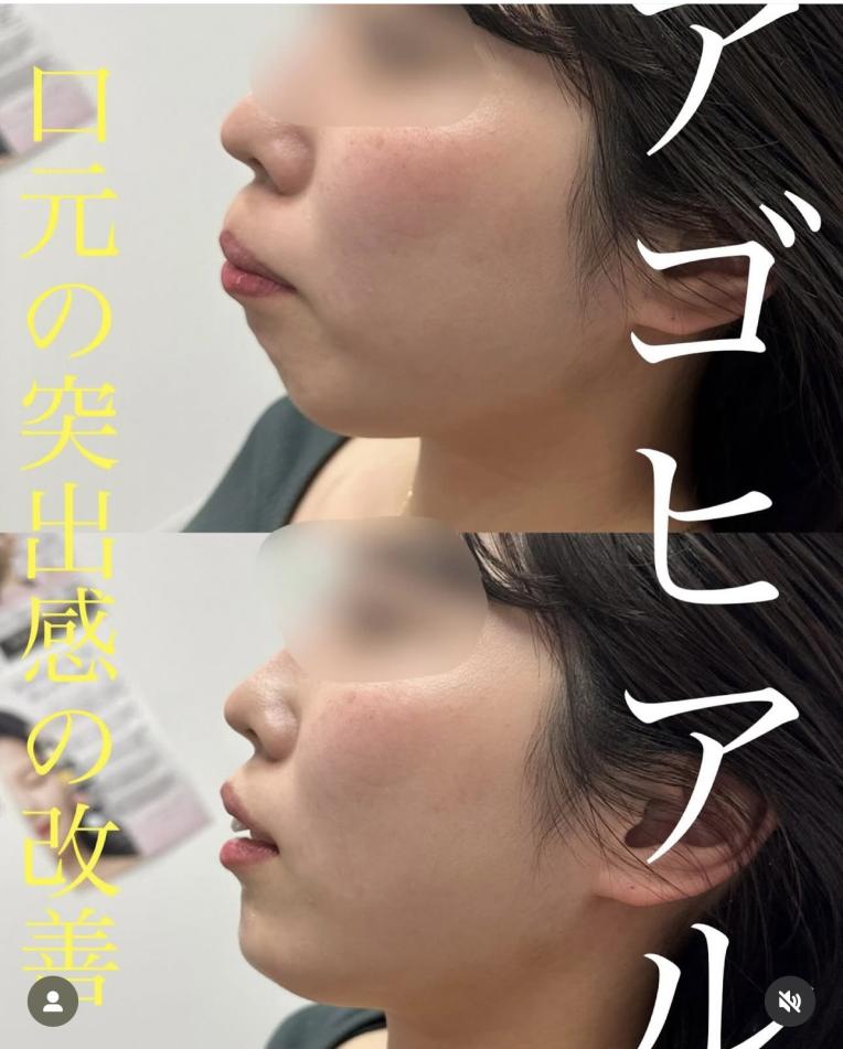 アゴクレヴィエルの症例写真