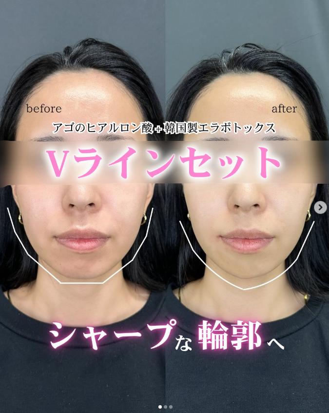 アゴクレヴィエルの症例写真